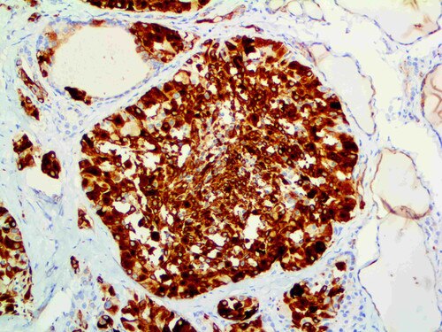 IHC of Cytokeratin 19 on an FFPE Thyroid Carcinoma Tissue